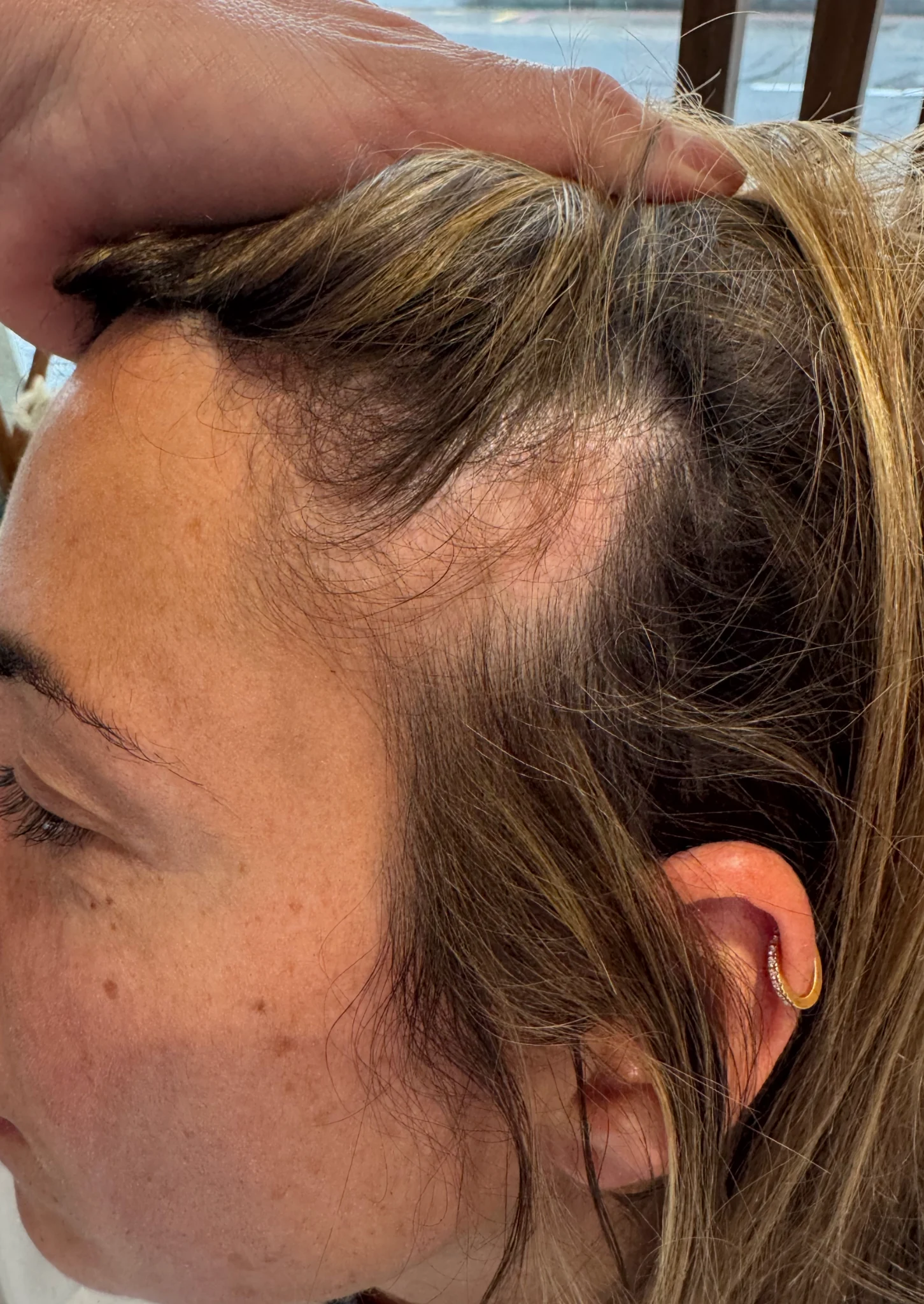 Alopecia triangular congénita en la zona temporal antes de micropigmentación