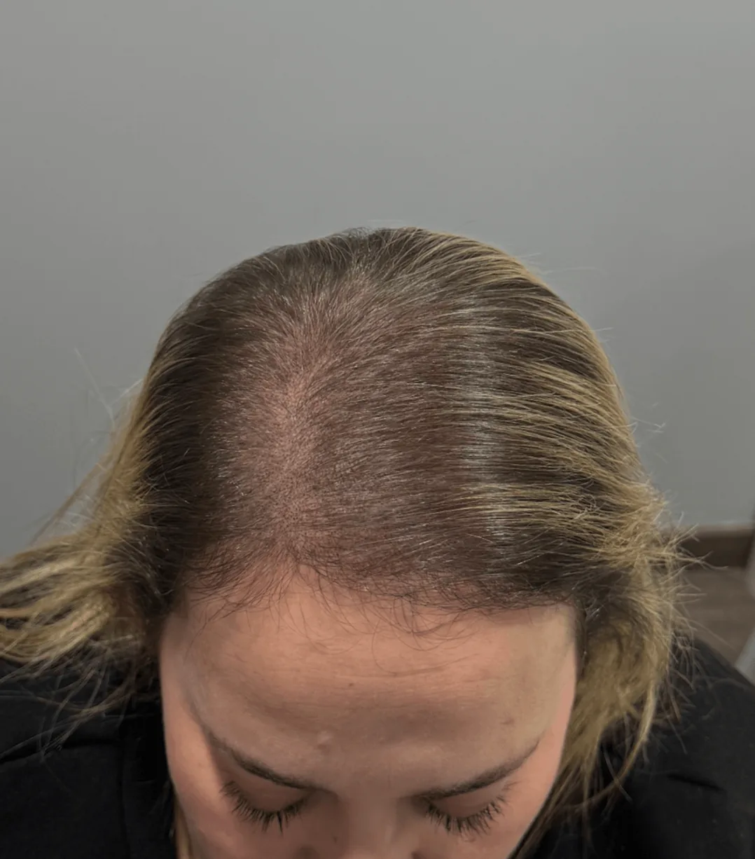 Resultado después de micropigmentación capilar caso 1