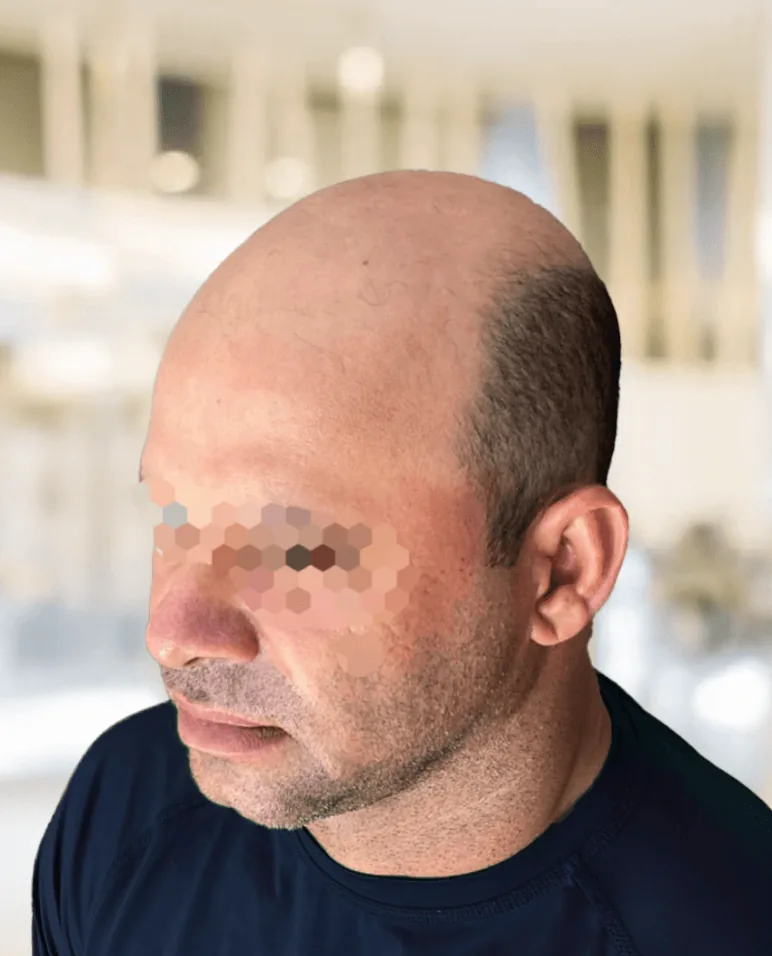 Situación antes de micropigmentación efecto rapado con reconstrucción de línea frontal