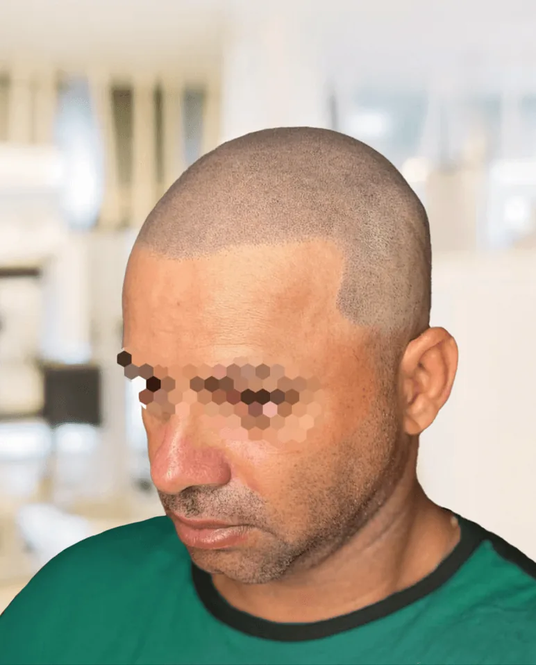Resultado después de micropigmentación efecto rapado con reconstrucción de línea frontal