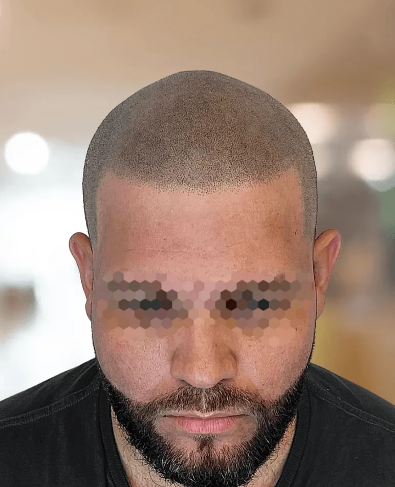 Resultado después de micropigmentación efecto rapado personalizada en piel clara