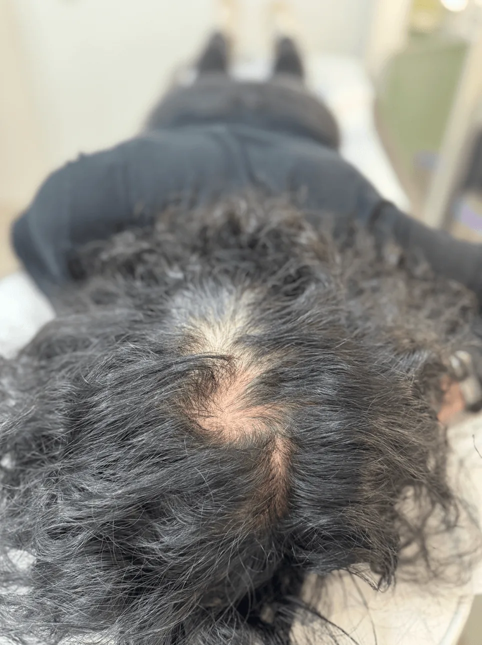Situación antes de micropigmentación capilar femenina integral para alopecia androgenética