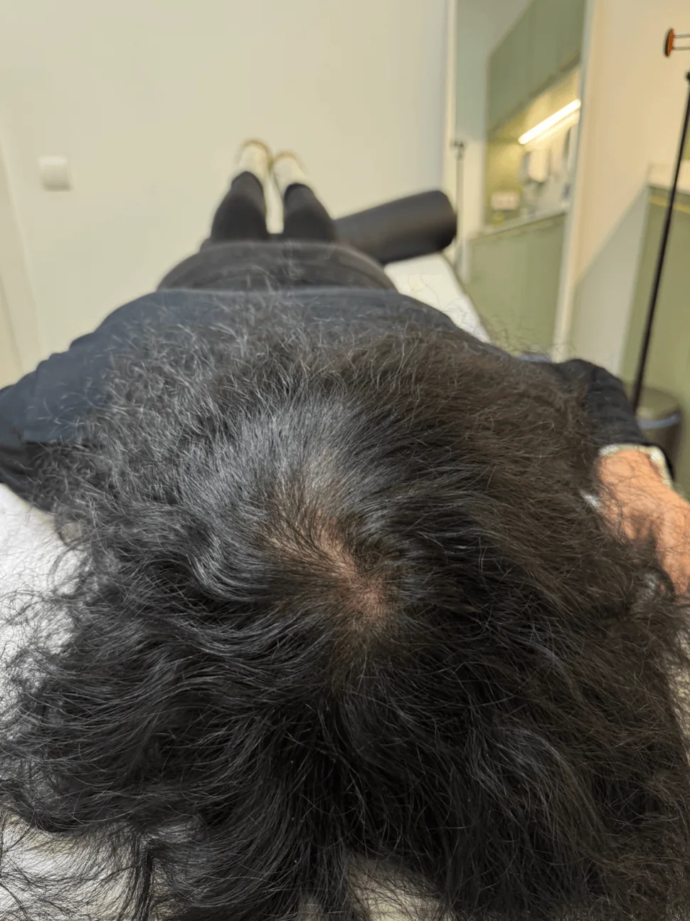 Resultado después de micropigmentación capilar femenina integral para alopecia androgenética