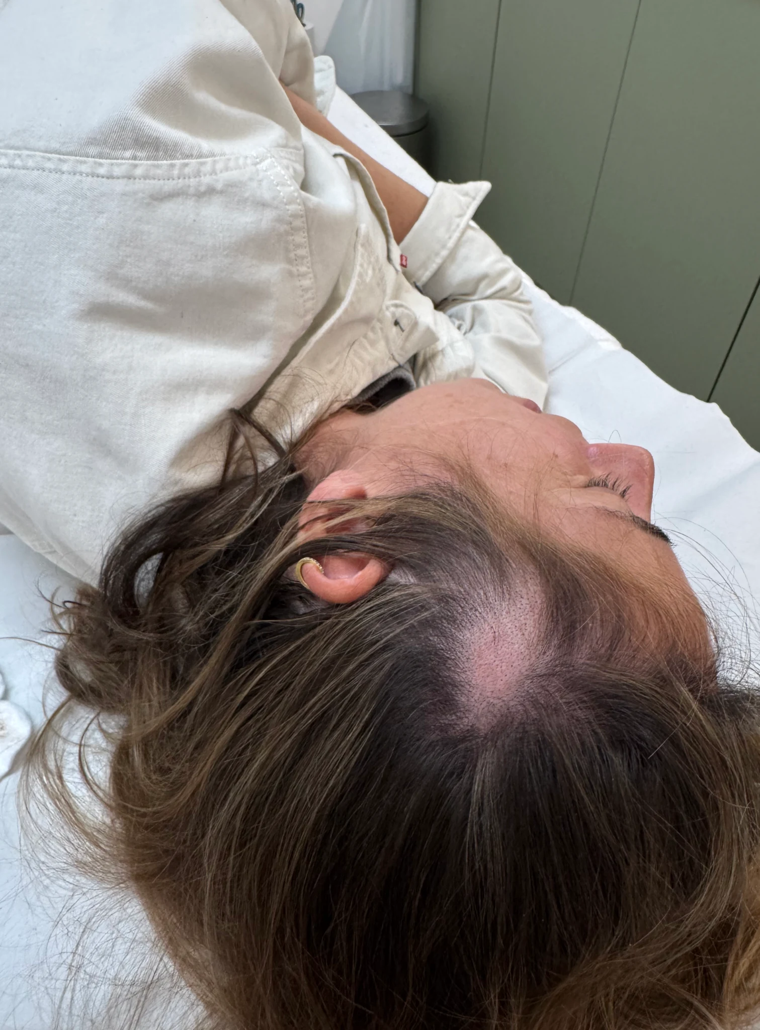 Situación antes de micropigmentación para alopecia triangular congénita en zona temporal