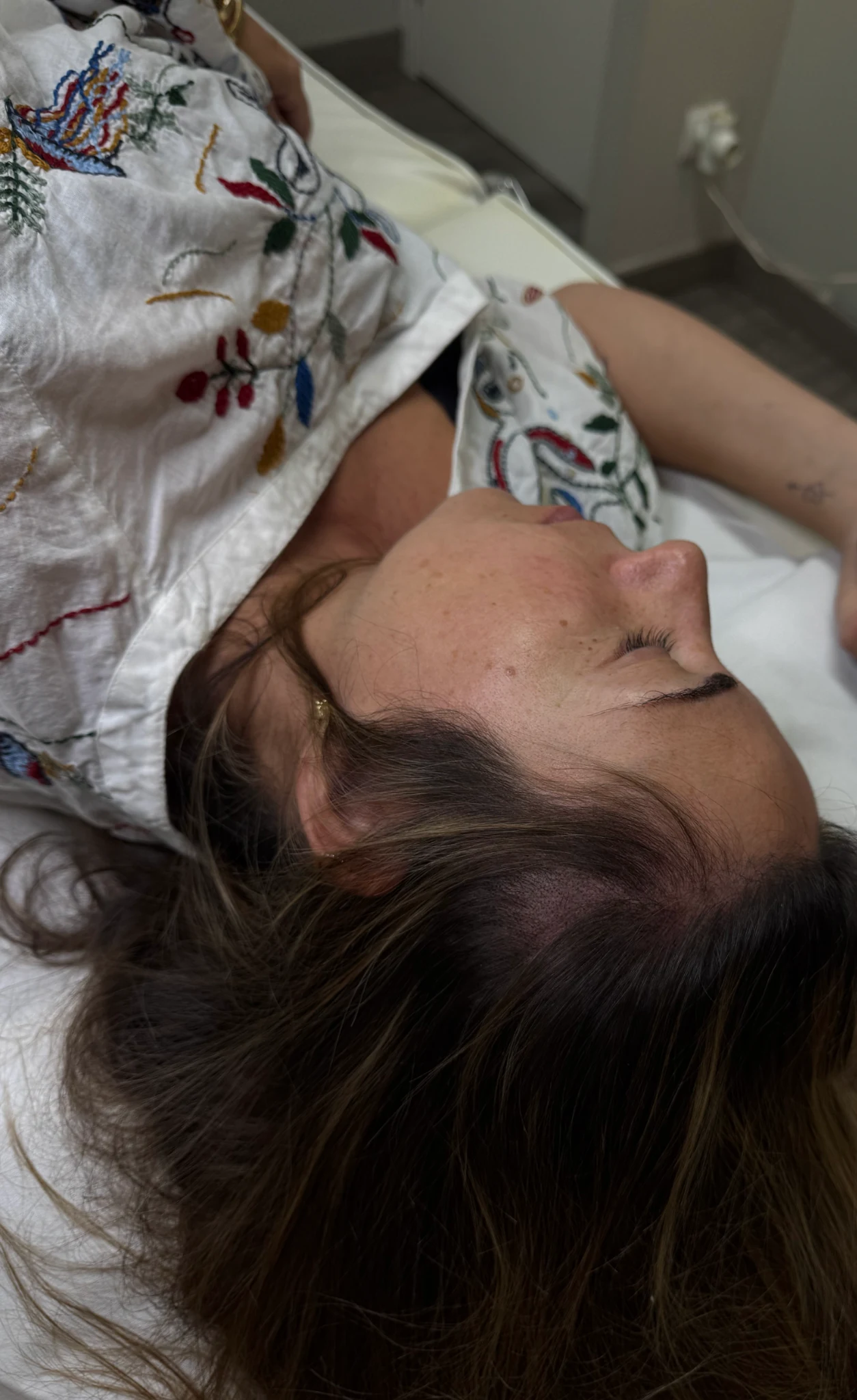 Resultado después de micropigmentación para alopecia triangular congénita en zona temporal
