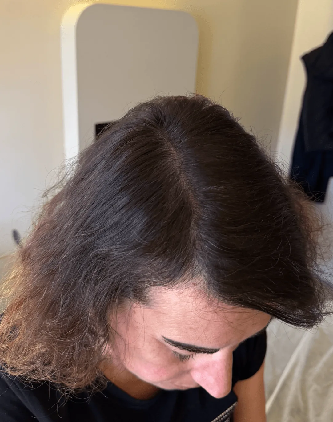 Resultado después de micropigmentación capilar caso 3