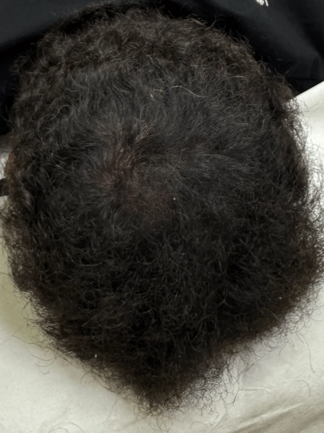 Resultado después de micropigmentación capilar caso 4