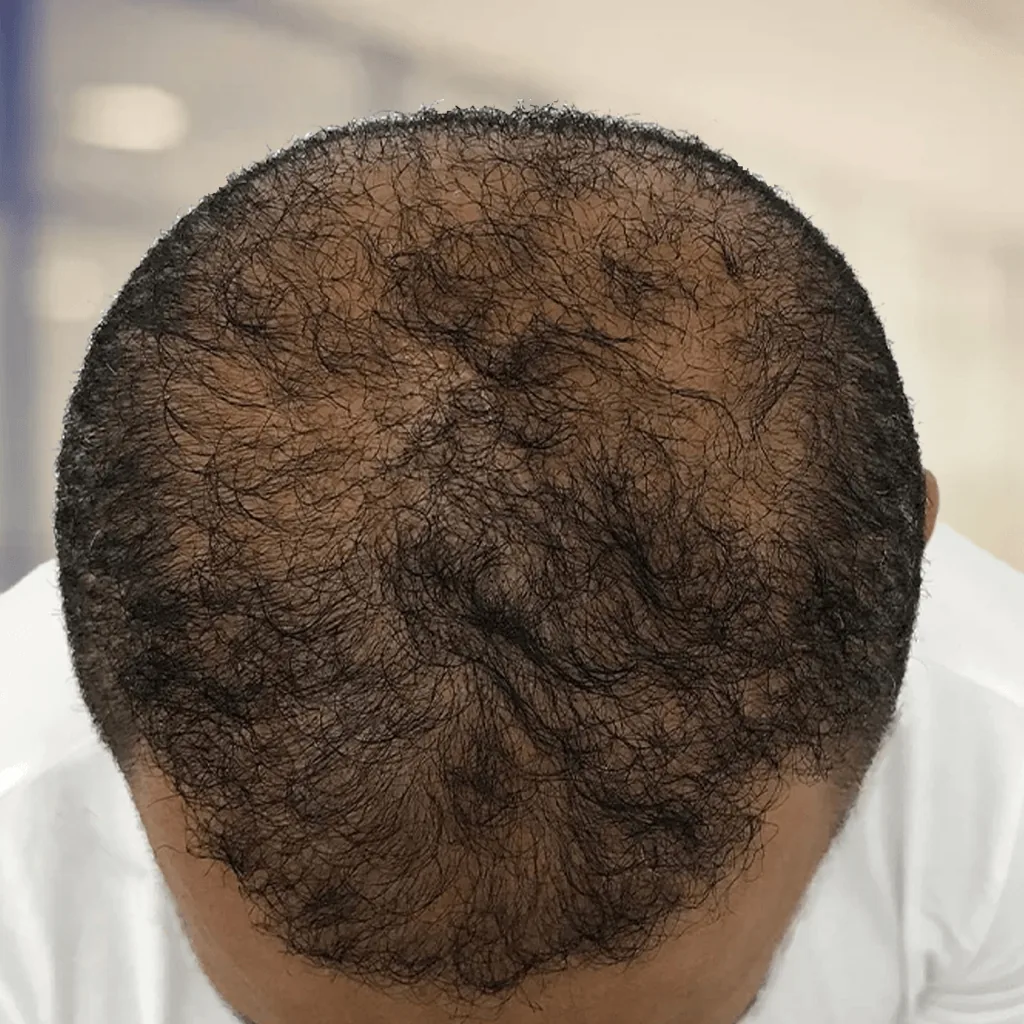 Situación antes de micropigmentación capilar de densidad masculina con pelo largo