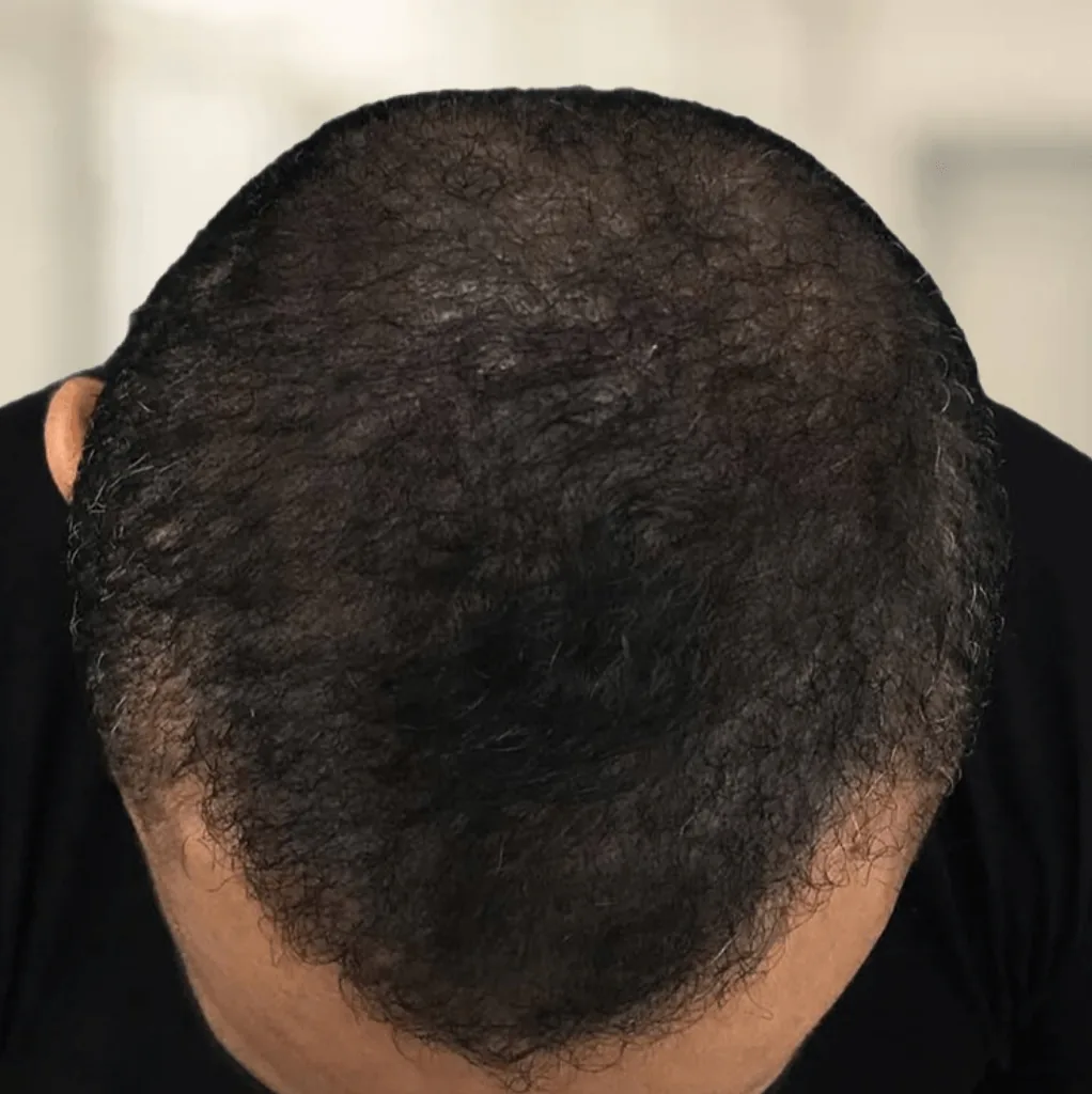 Resultado después de micropigmentación capilar de densidad masculina con pelo largo