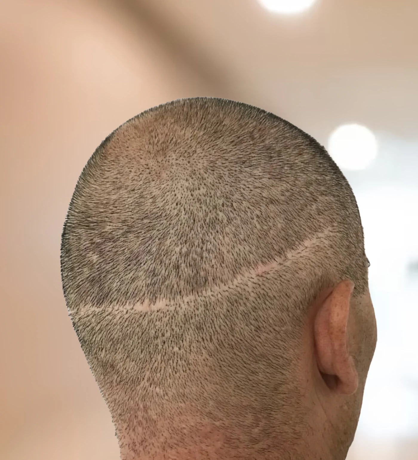 Cicatriz lineal capilar antes de micropigmentación