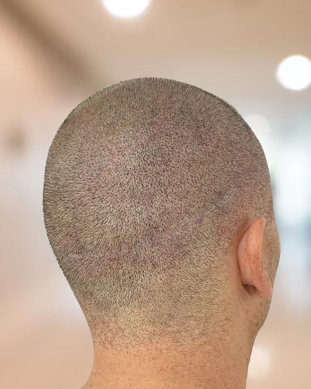Resultado después de micropigmentación para camuflar cicatriz lineal FUSS en zona donante