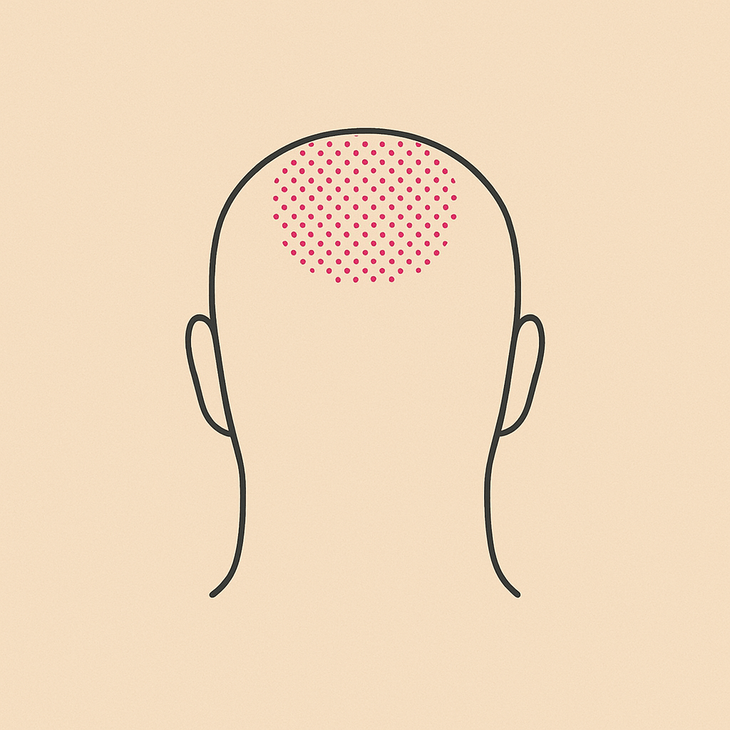 Micropigmentación coronillas