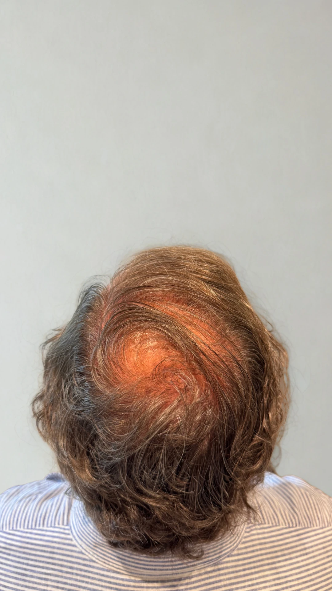 Micropigmentación capilar efecto densidad en hombre con cabello existente