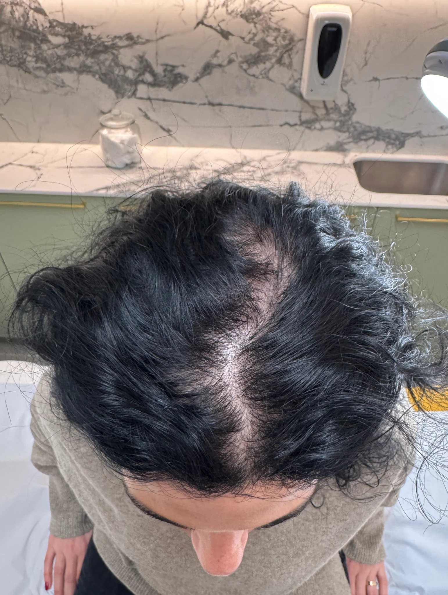 Mujer con pérdida difusa de densidad y cuero cabelludo visible en la zona superior