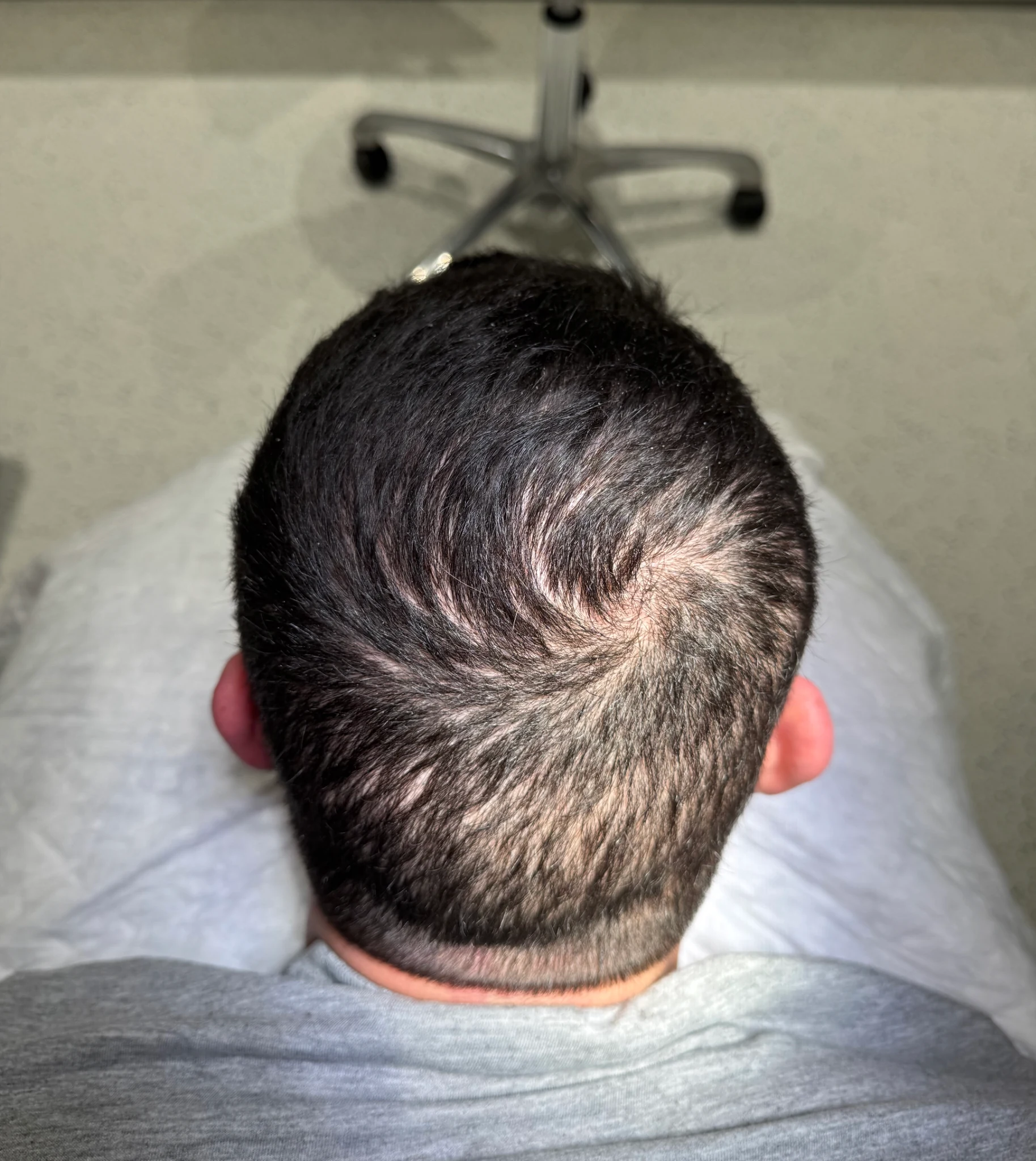 Zona posterior y coronilla con diferencias de densidad para valoración de micropigmentación después de injerto capilar