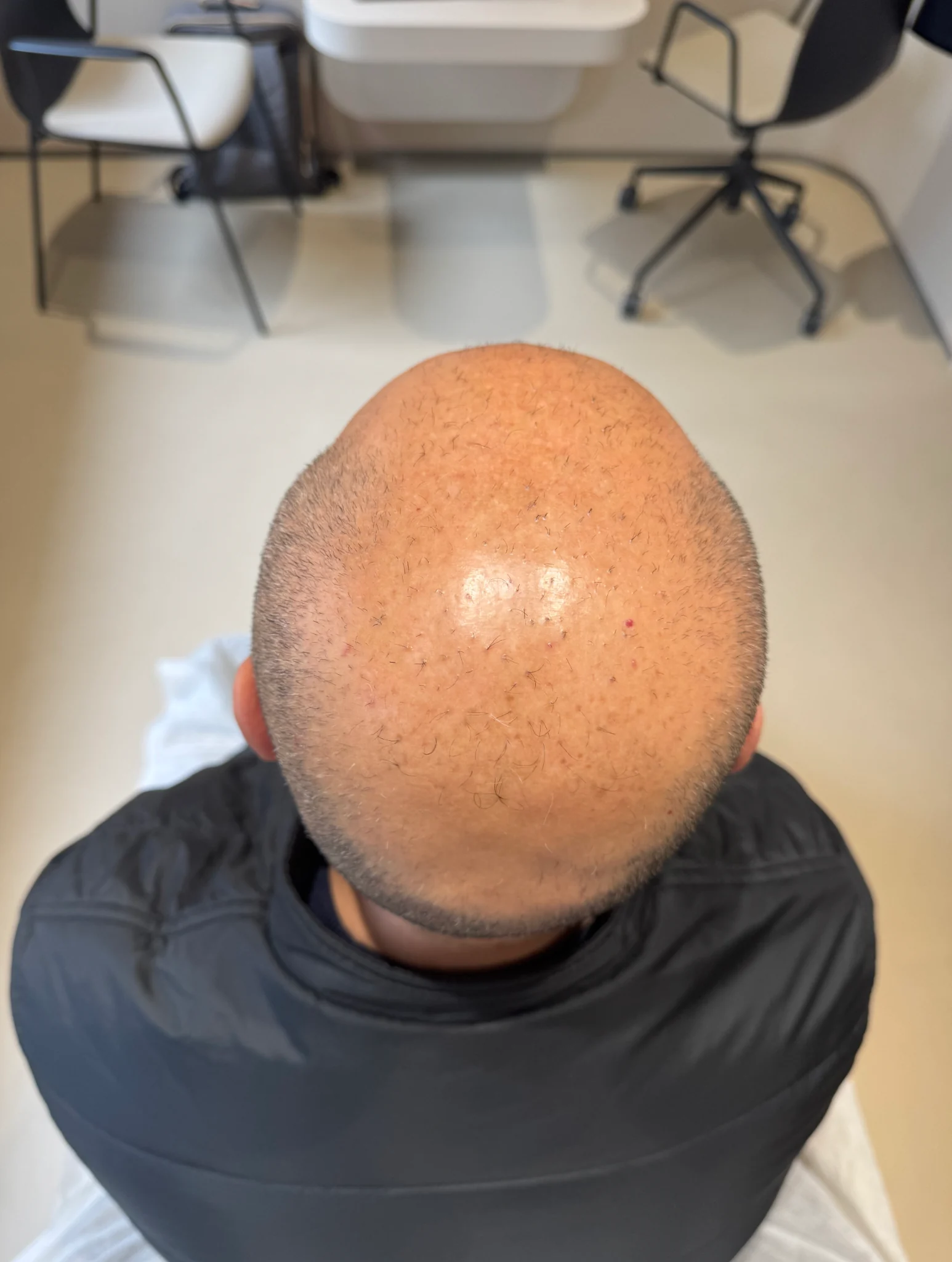 Micropigmentación efecto rapado