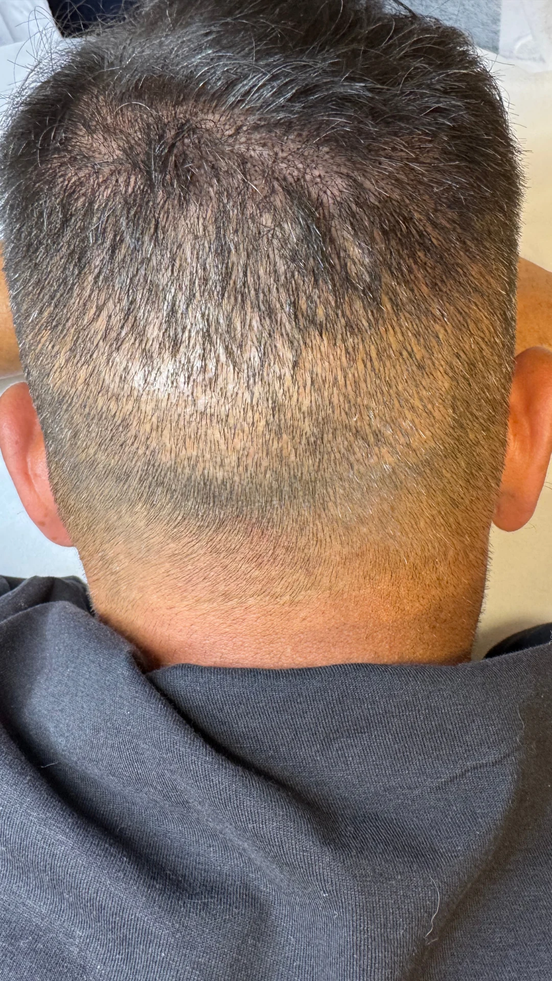 Zona donante con menor densidad tras extracción capilar